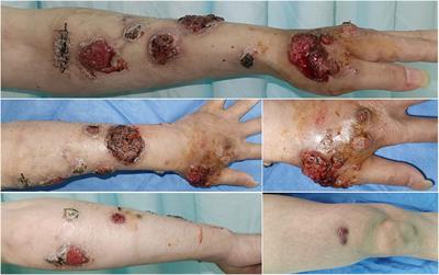 Oral treatment with 10% potassium iodide solution for refractory cutaneous-disseminated <mark class="highlighted">sporotrichosis</mark> in an immunocompetent adult: Case report